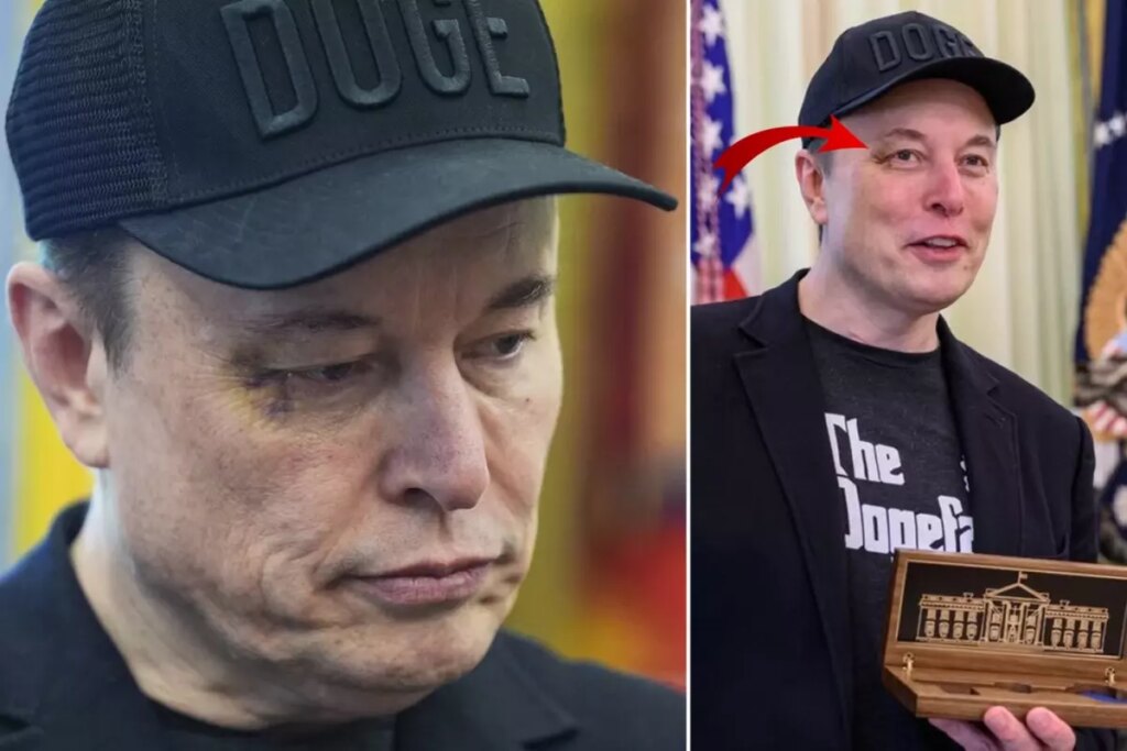 Elon Musk’ın gözündeki morlukla ilgili bomba iddia