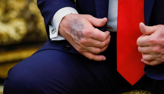 O ziyaret sırasında dikkat çekti! ABD Başkanı Trump’ın elindeki morluk gündem oldu: Beyaz Saray’dan açıklama geldi