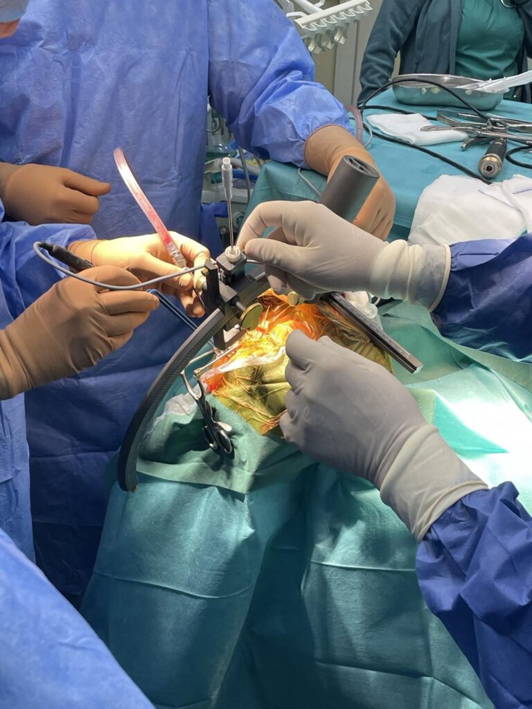 Beyin Cerrahisinde bir ilk: Stereotaksi sistemiyle beyin ameliyatı gerçekleştirildi